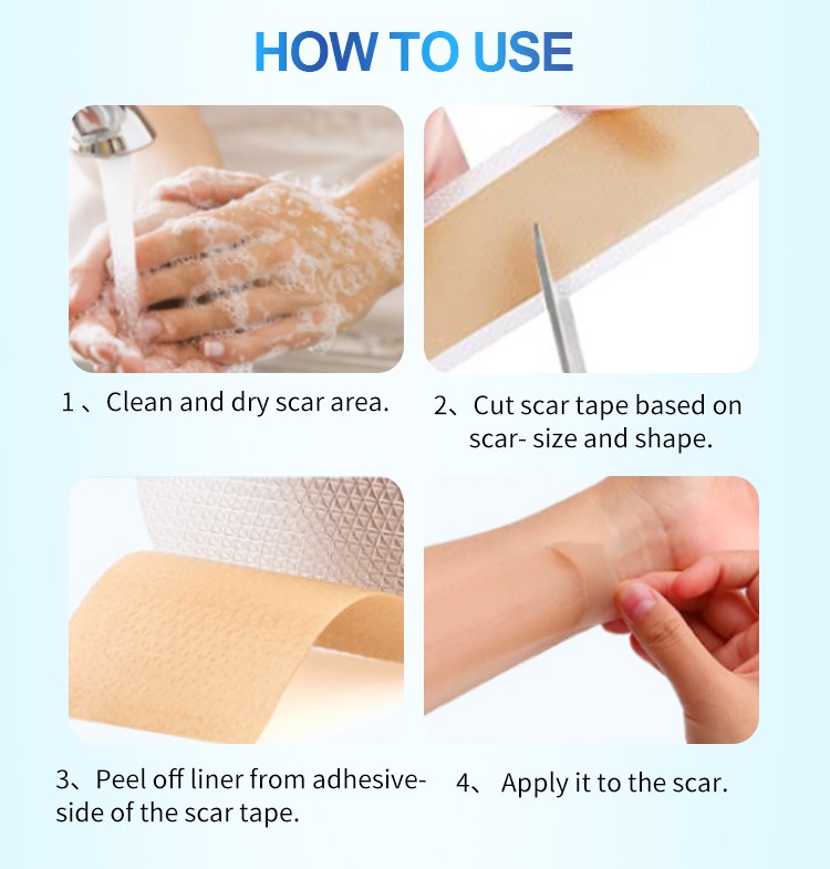 Silicone scar sheets