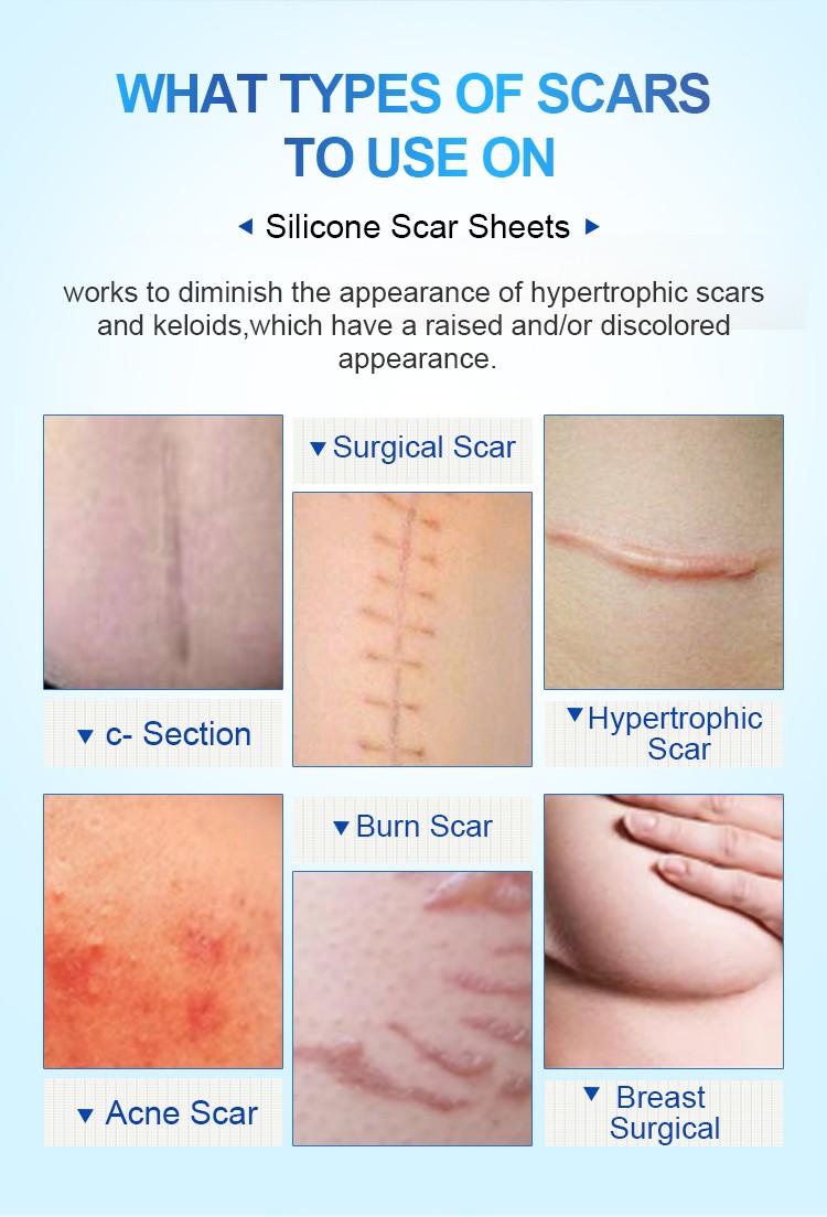 Silicone scar sheets